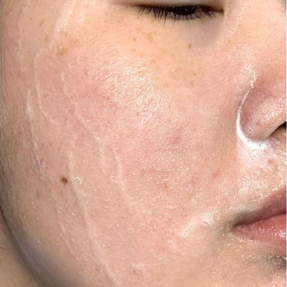 ▤✗  Sữa Rửa Mặt Dạng Gel Eucerin Acne-Oil Control Pro Acne Solution Cleansing Gel