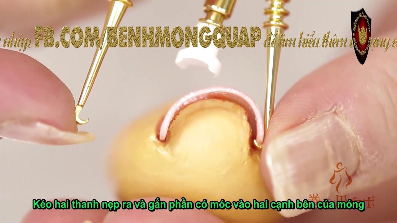 dụng cụ chữa quặp móng chân khỏi đau do móng đâm vào thịt