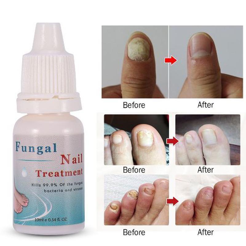 Nail Repair Liquid Treatment with File Nail Anti Remove Nail Onychomycosis Fungus Toe Nourishing Brighten Nail giá rẻ