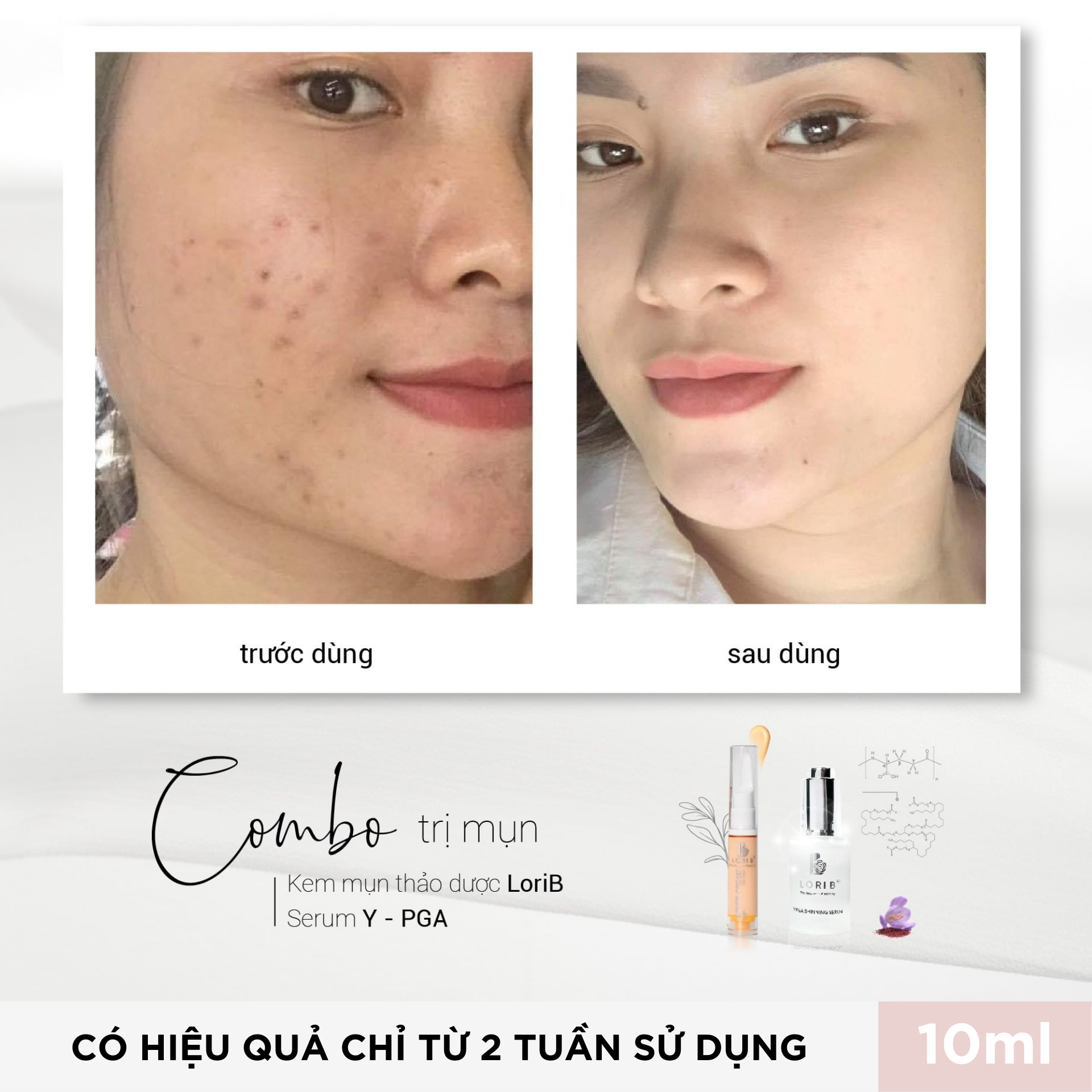 Combo Kem mụn - Sữa rửa mặt Lori B