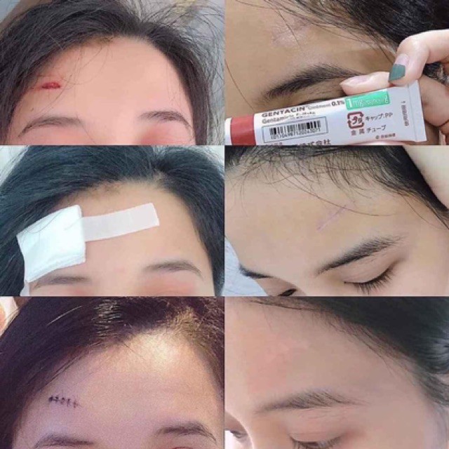 Kem ngừa sẹo Gentacin của Nhật