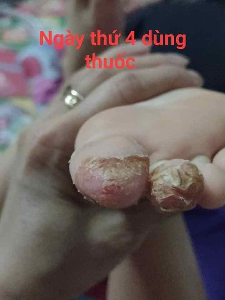 VIÊM DA TRẦN KIM HUYỀN