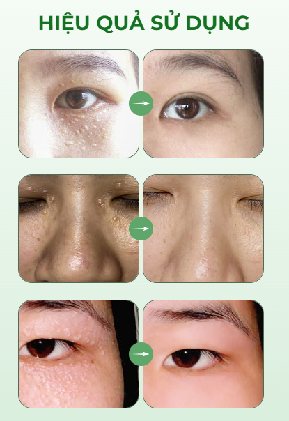 Kem  bơ giảm mụn thịt Yaquinuo nội địa Trung