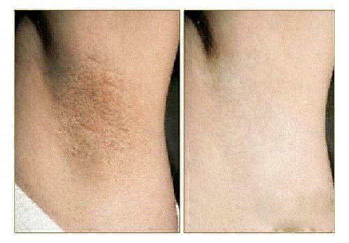 [HCM]Kem DIDIE Trắng Nách Mịn Da Xóa Thâm