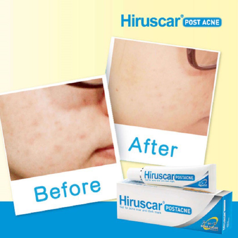HIRUSCAR POST ACNE (TUÝP 5/10gr) - GEL LÀM MỜ SẸO VÀ THÂM MỤN [Hirusca, post acnes, postacne]