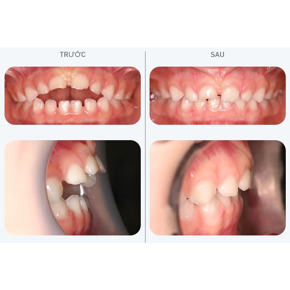 [Y Tế Bạch Mai] Dụng Cụ Niềng Răng Trainer T4K Hàng ÚC
