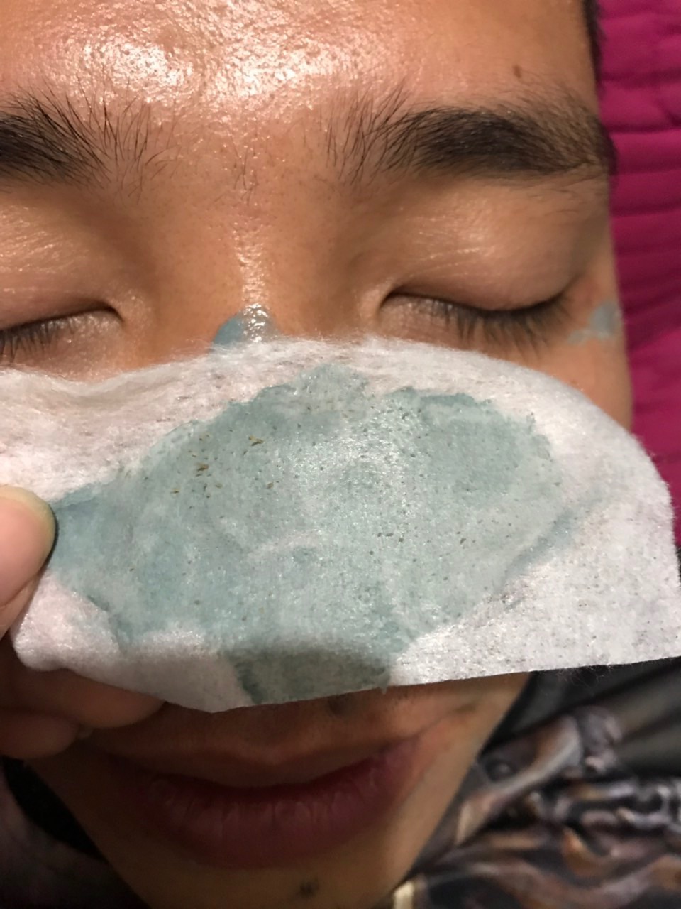 Gel Hút Mụn ( Combo 5 hộp )