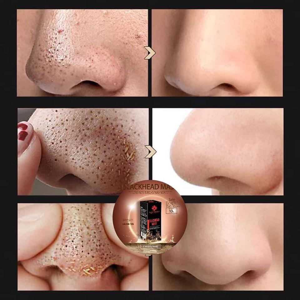 Miễn Phí Ship. Lột Mụn Đầu Đen BLACKHEAD MASK