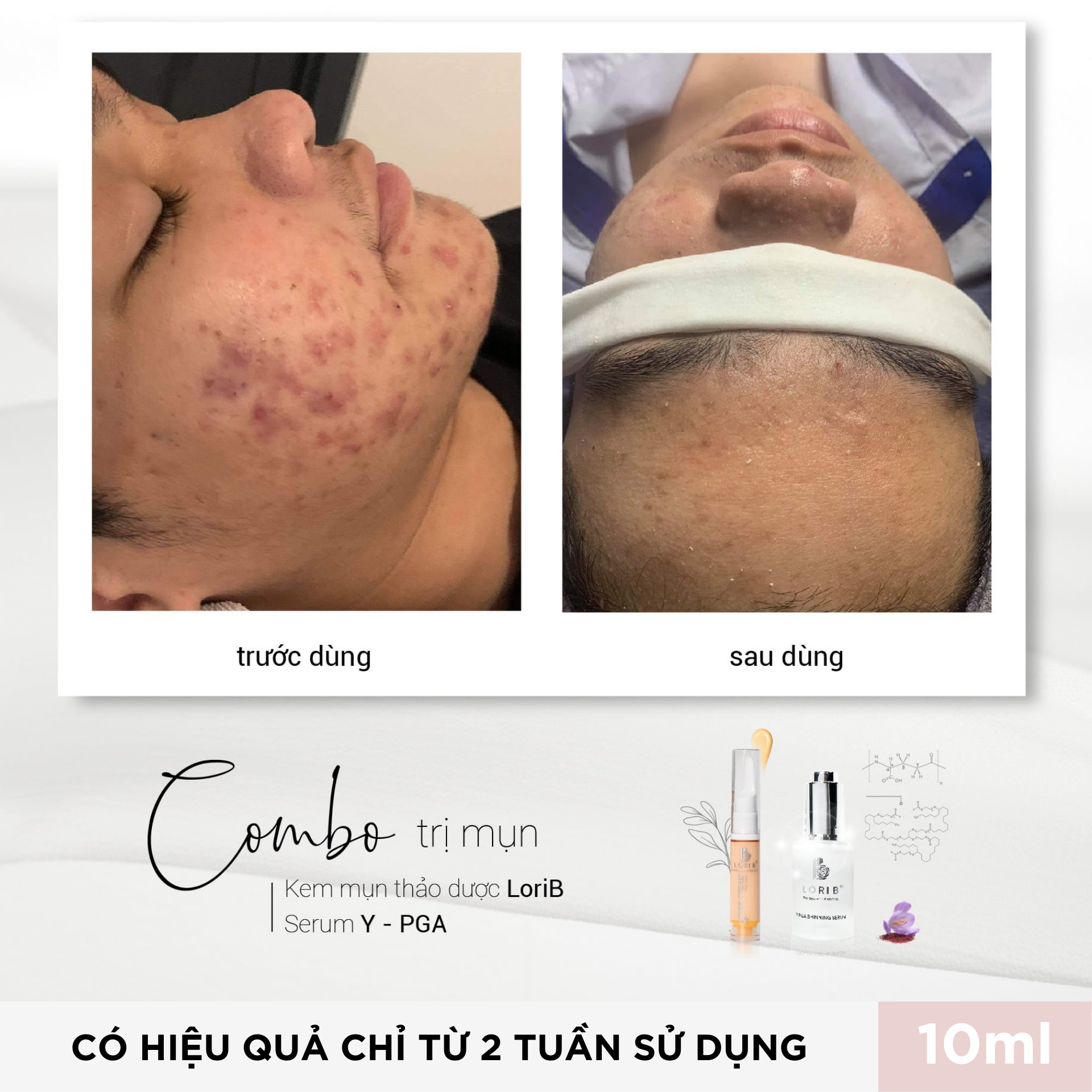 Combo Kem mụn - Kem thâm Lori B