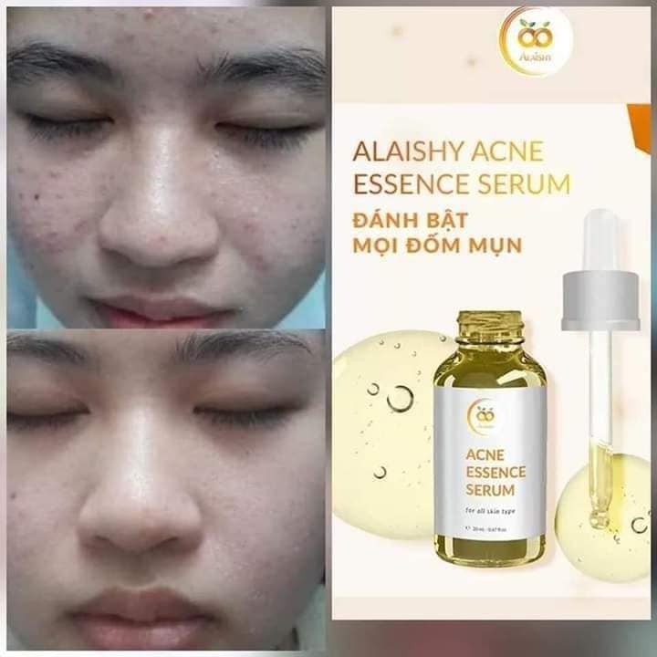 SERUM MỤN ALAISHY VITAMIN C - TINH CHẤT NGHỆ
