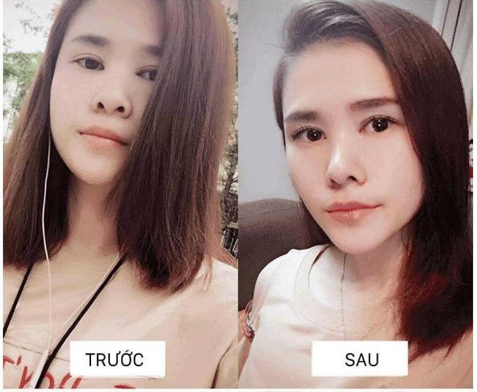 [HCM]Bộ dụng cụ nâng mũi 3D Hàn Quốc #NM6