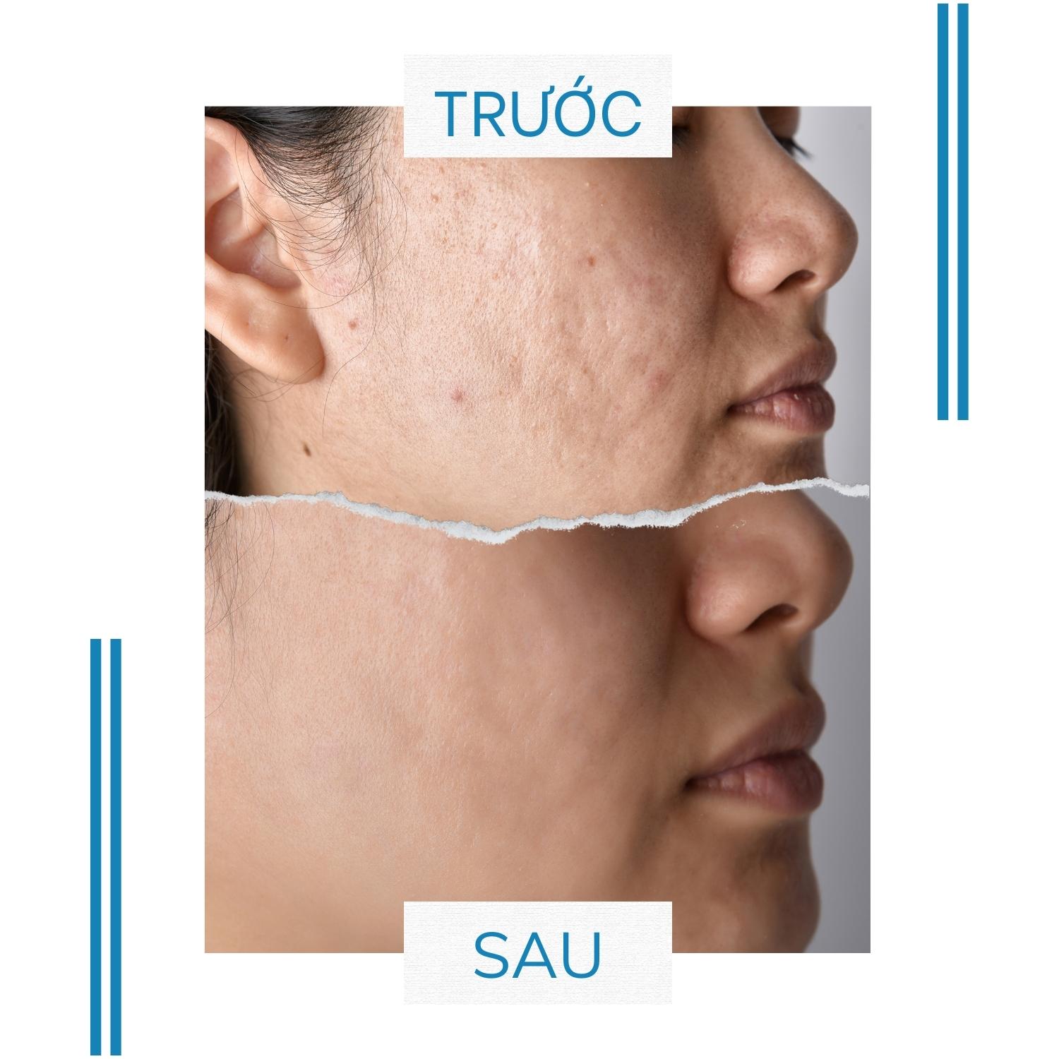 Serum Tri Mụn thâm Doctor Care Acnes Elimination 20ml