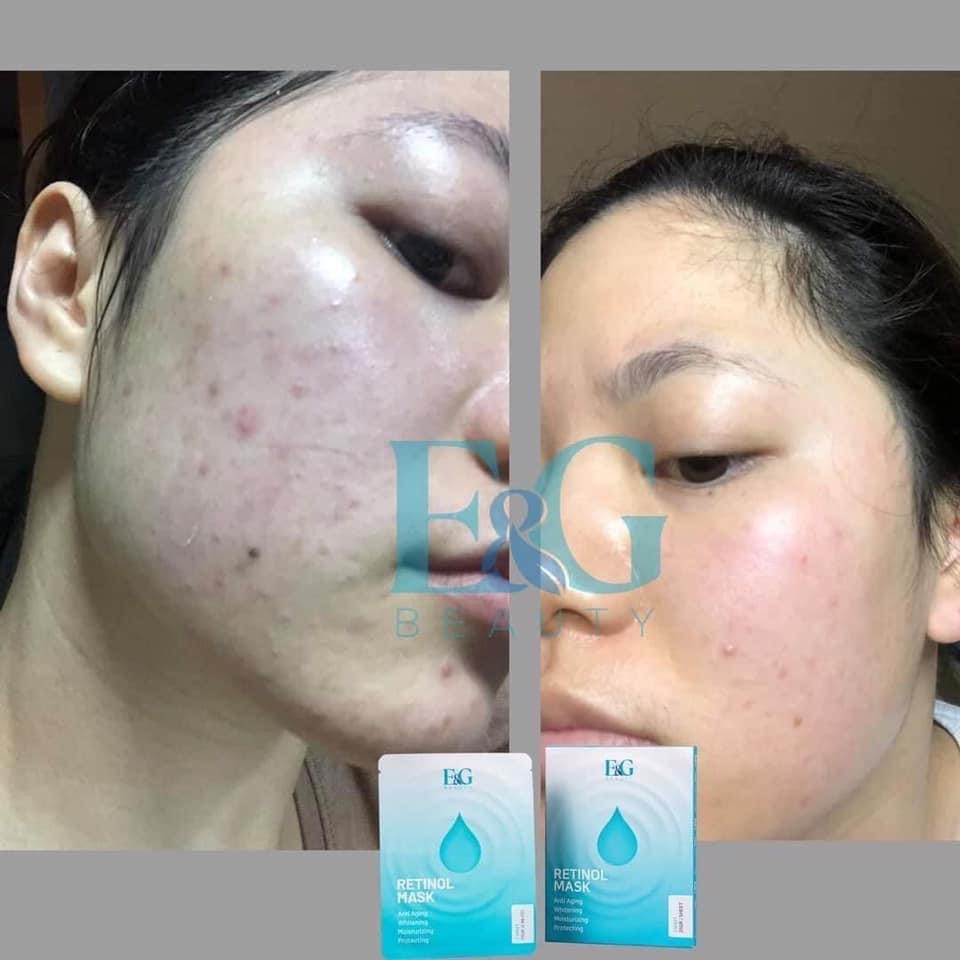 Mặt nạ RETINOL E&G trắng da trẻ hóa làn da