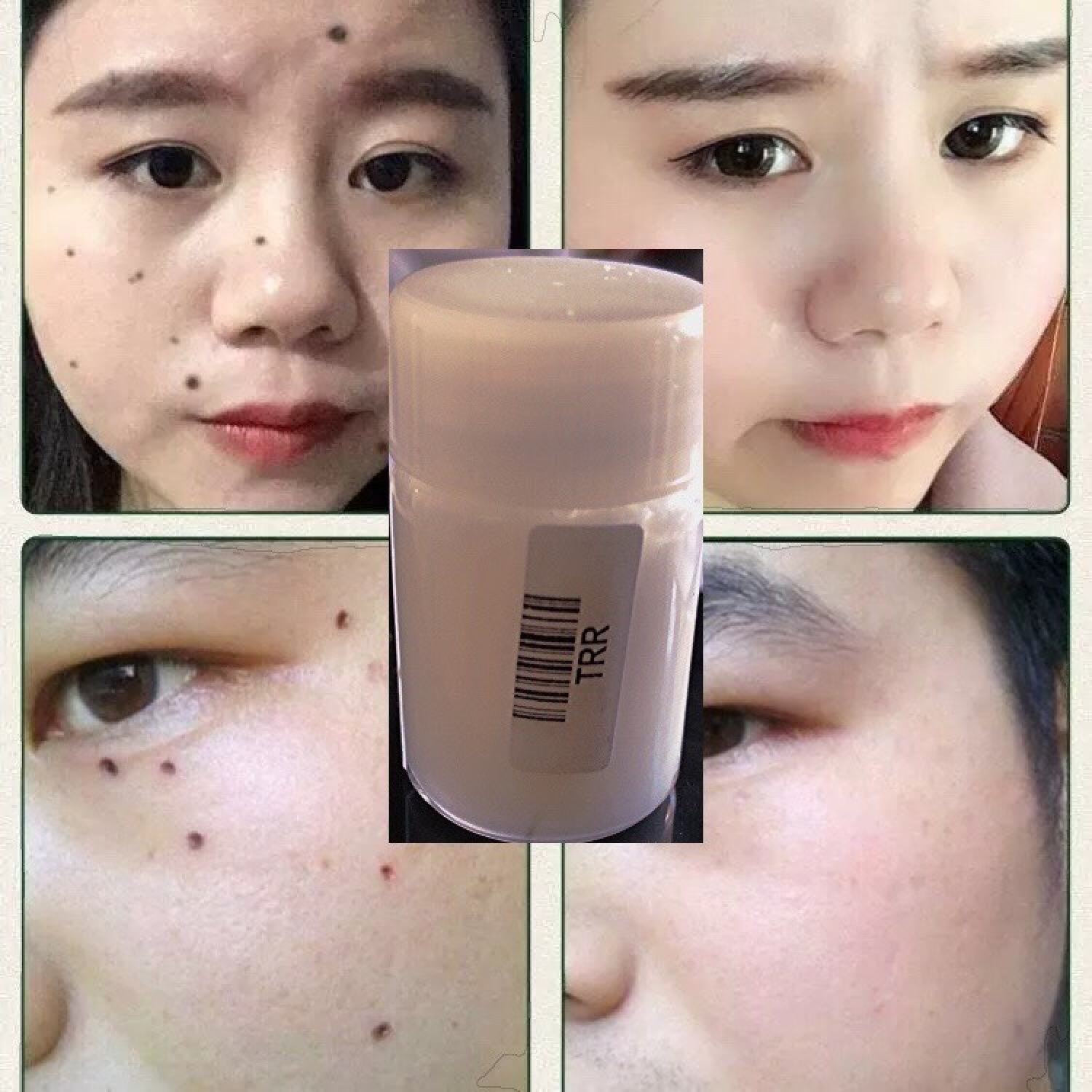 Tẩy nốt ruồi Kem xóa Եàn nhang mụn thịt hiệu quá nhanh chóng