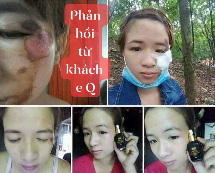 TINH DẦU TRỊ THÂM CAO CẤP LINH HƯƠNG