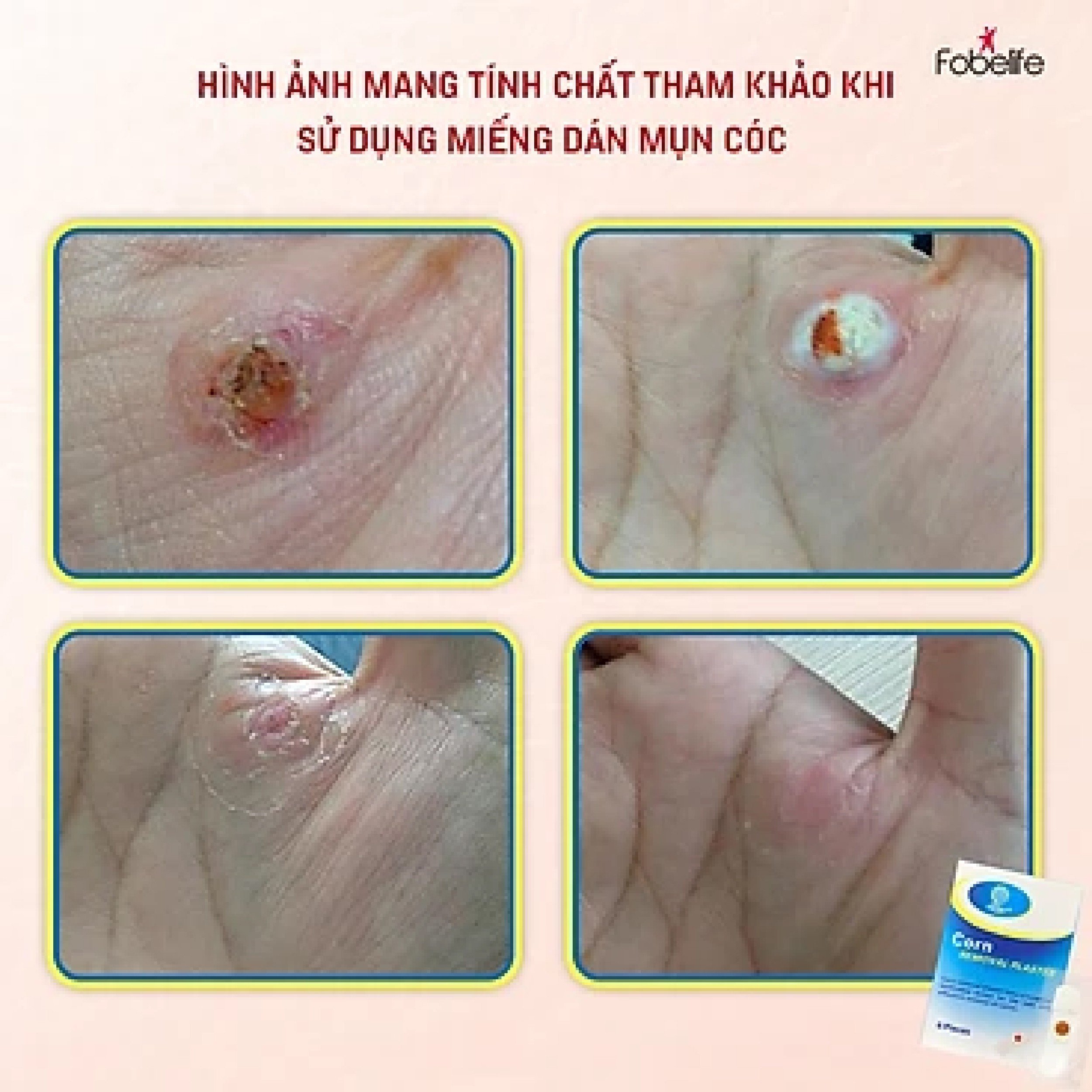 Miếng Dán Mụn Cóc Mụn Cơm Corn plaster KangDi Fobe - hộp 6 miếng