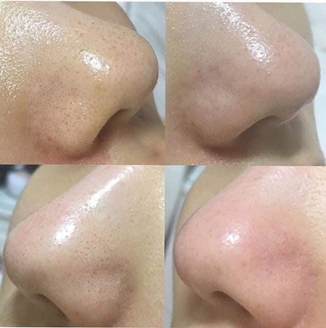 (CHIẾT 100ML) Ủ MỤN ĐẦU ĐEN Medipeel Extra Super 9 100ml [Chính Hãng] [Mẫu mới]