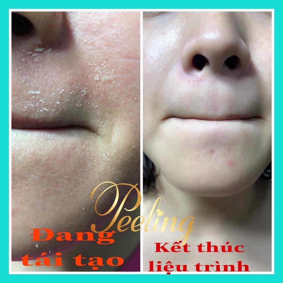 [HCM]kem Peeling Tái tạo da