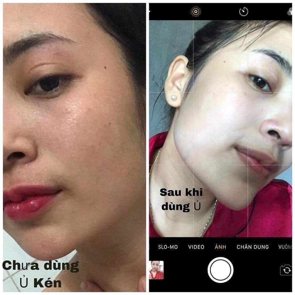 Ủ Trắng Da Kén Tằm chính hãng