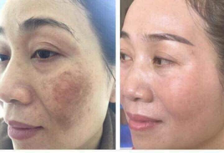 KEM XÓA NÁM,TÀN NHANG CCM THÁI LAN