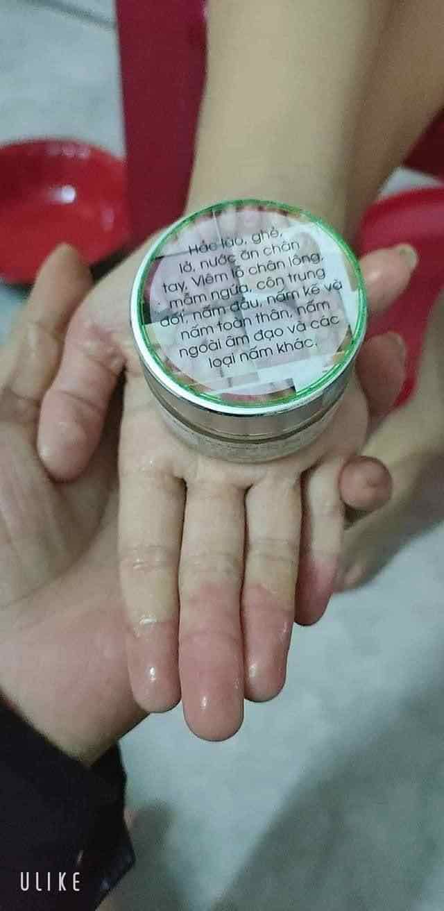 VIÊM DA TRẦN KIM HUYỀN