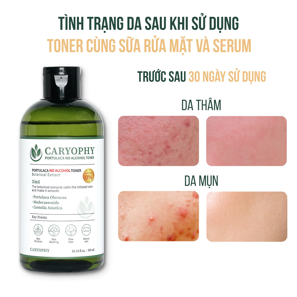 Combo chăm sóc da giảm mụn mờ thâm Caryophy Portulaca (Serum giảm mụn 10ml - Toner không cồn 300ml)
