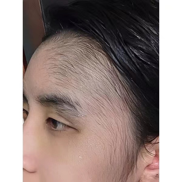 Minoxidil 15% (Bán chạy nhất) (Niêm phong) Sản xuất tại Thái Lan đích thực