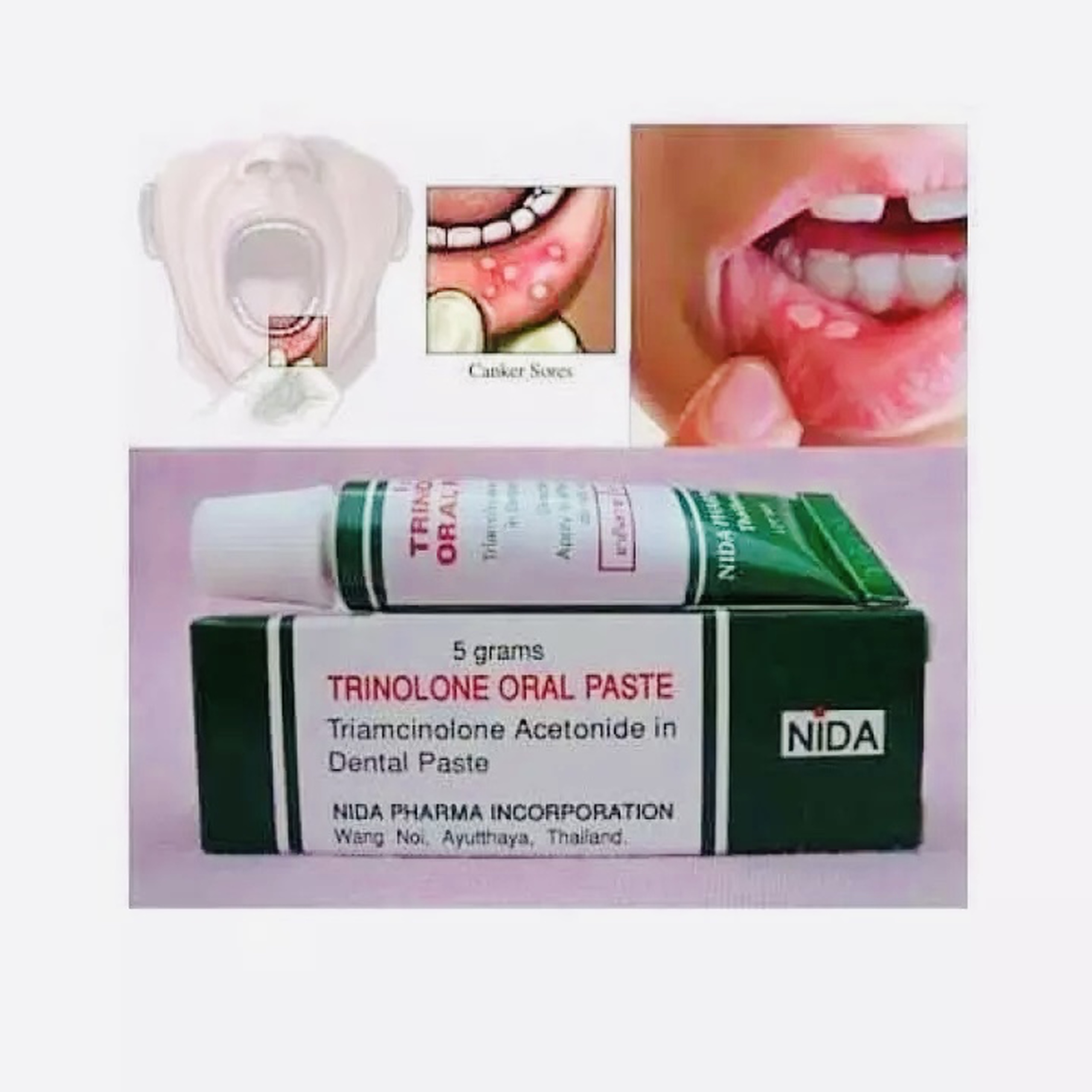 [HCM]Kem bôi nhiệt miệng Trinolone Oral Paste THÁI LAN