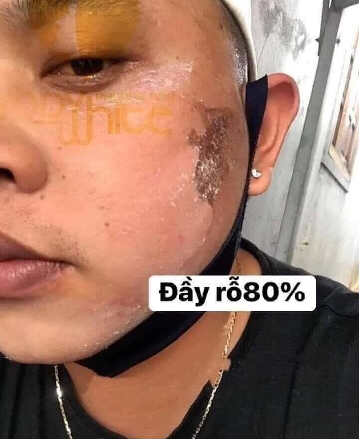 CHẤM TÀN NHANG MỤN NÁM RỖ PHƯƠNG ANH