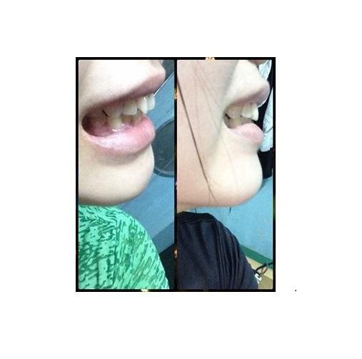 DỤNG CỤ NIỀNG RĂNG │Thế Hệ Mới 2019 - Bộ 3 hàm A1 + A2 + A3