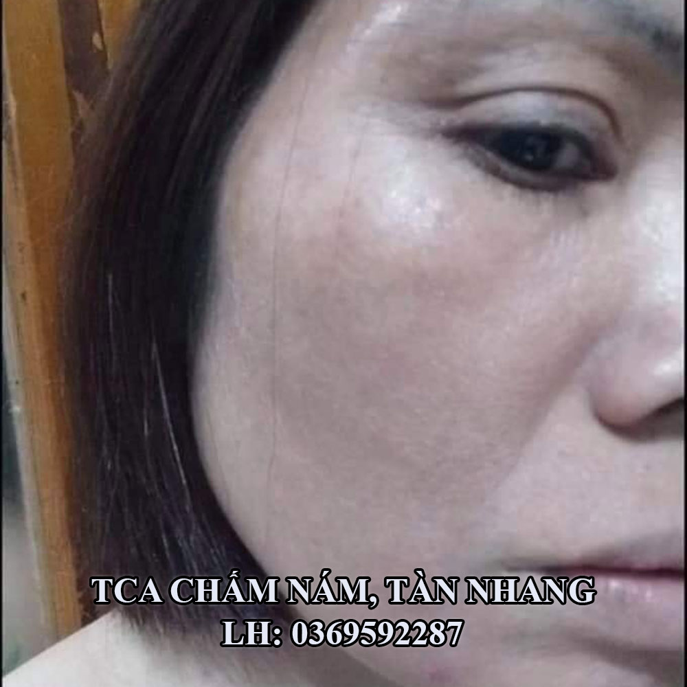 Chấm nám, tàn nhang, làm đầy sẹo rỗ Đức Thịnh 1ml Handmade
