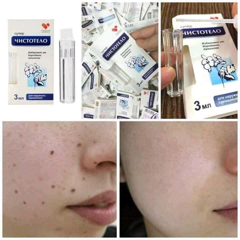 Serum tẩy Mụn Cóc - Gel Tẩy Nốt Ruồi