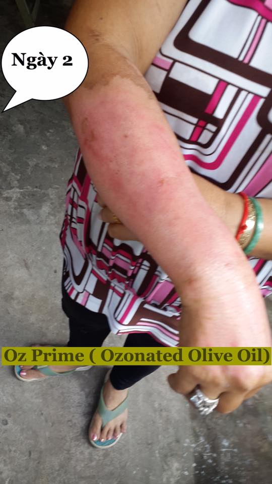Kem làm mờ sẹo ORO M OZONATED OLIVE OIL Hàn Quốc