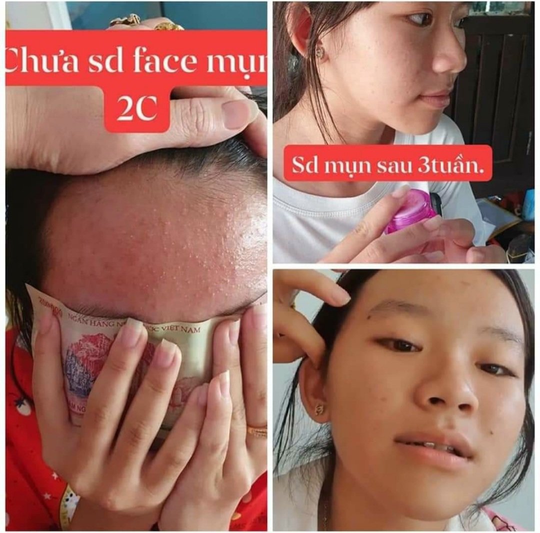 Combo 5 Hộp Kem Mụn 2C