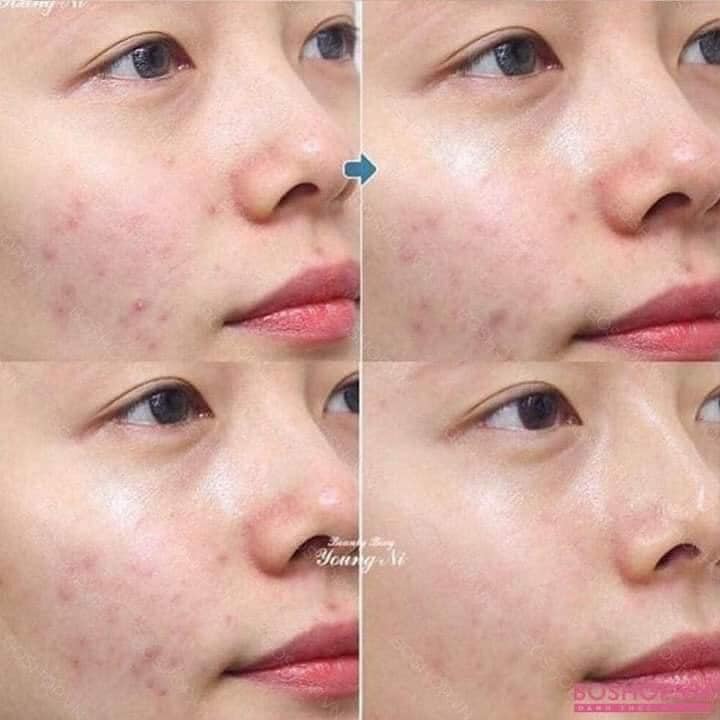 Gel TRỊ Mụn Trứng Cá Megaduo 15g