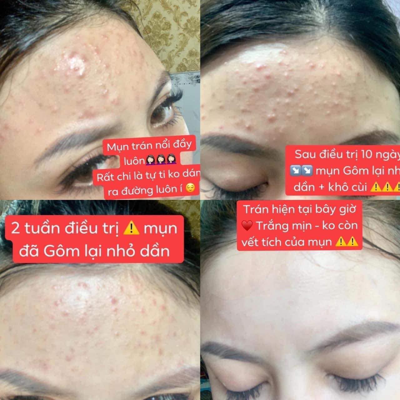 Kem mụn ngừa thâm Fairy 15gr