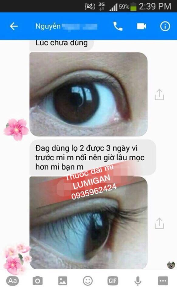 Thuốc mọc lông mày, dài mi Lumigan - Mỹ