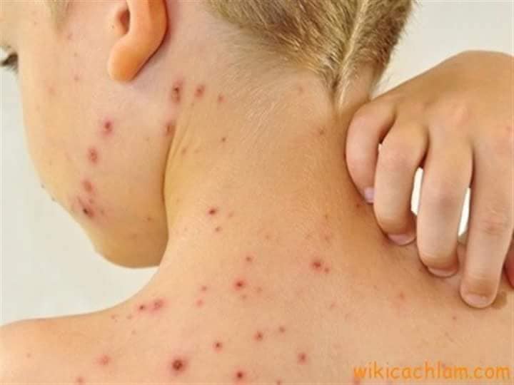 Combo 2 chai chấm mụn FOB 10 Lotion