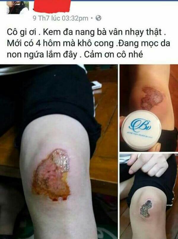 Đông Y Đa Năng Bà Vân Các Bệnh Ngoài Da