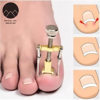 Dụng cụ chữa móng quặp, móng chân chọc thịt đau đớn