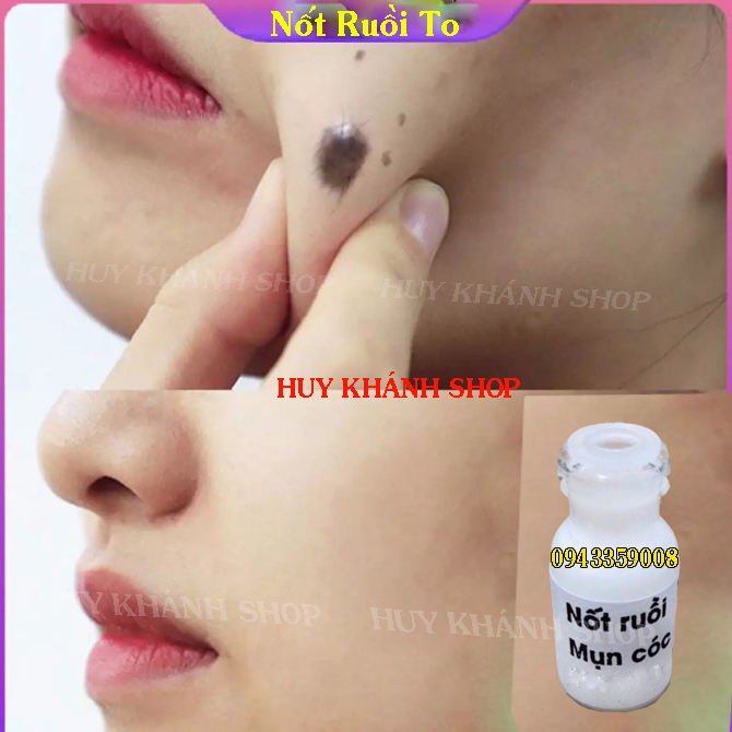 XOA NOT RUOI, TAN NHANG , MUN COC, MUN THIT