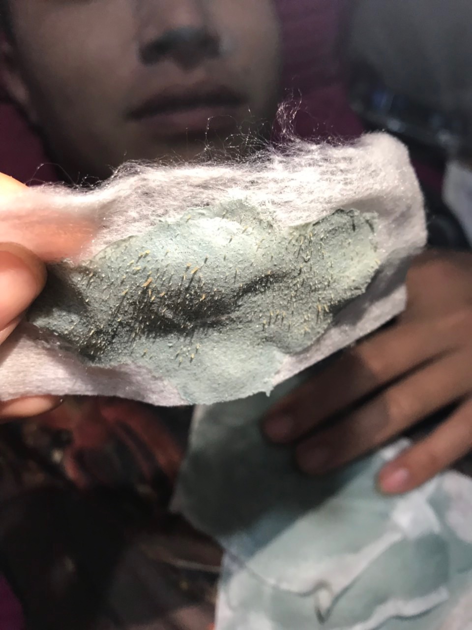 Gel Hút Mụn ( Combo 5 hộp )