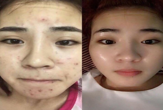 Tinh Chất Mụn Linh Hương Purity Skin (cam kết chính hãng)
