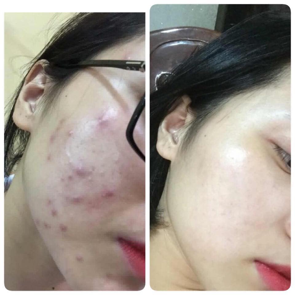 Serum Thay Da Nhân Sâm MQ Skin (Không Sưng)
