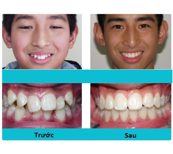 [HCM]DỤNG CỤ NIỀNG RĂNG │Lẻ hàm A3