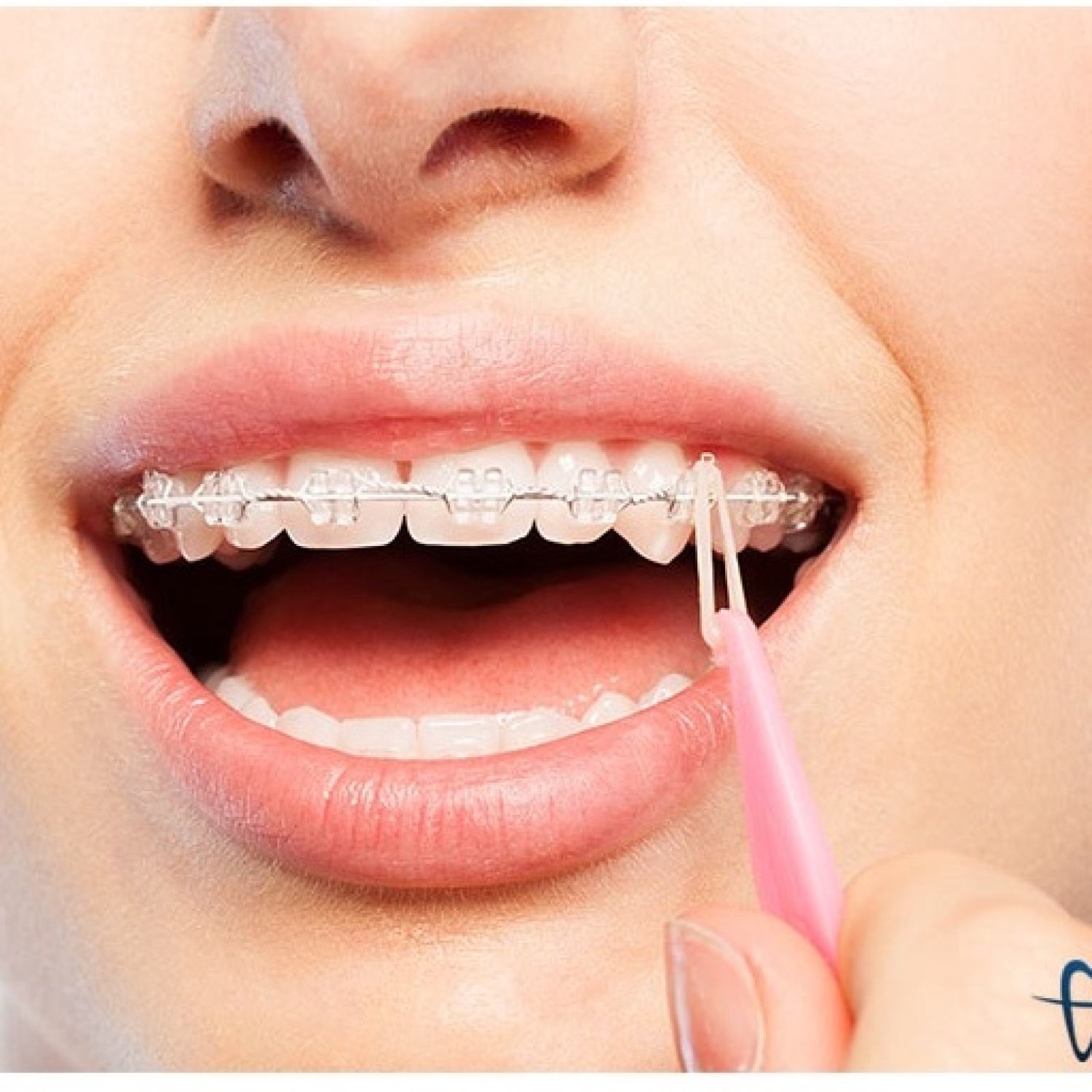 Cây móc chun liên hàm-cây móc thun niềng răng