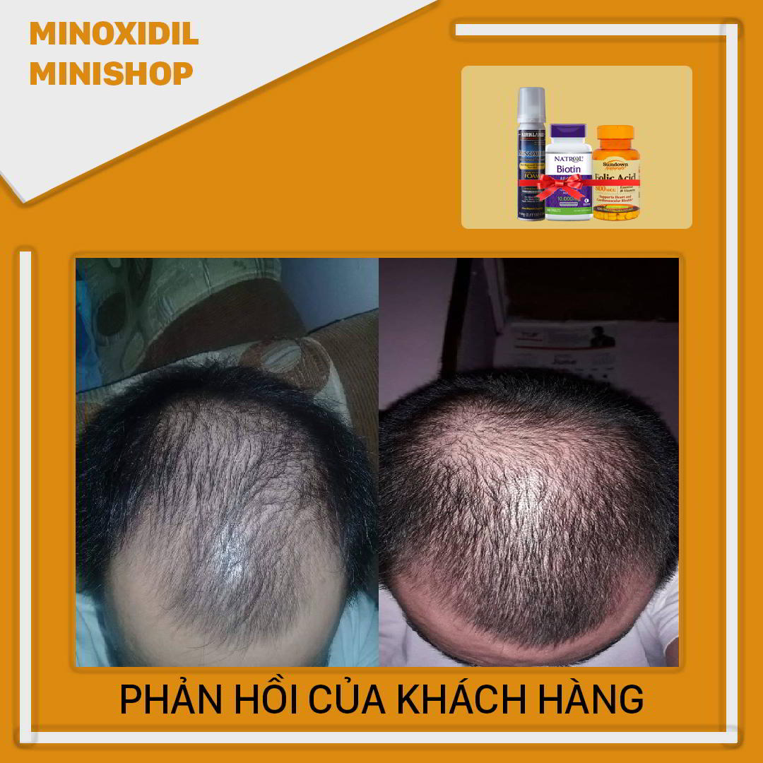 Minoxidil 5% Dạng Bọt Mọc Râu Tóc Combo Biotin Folic