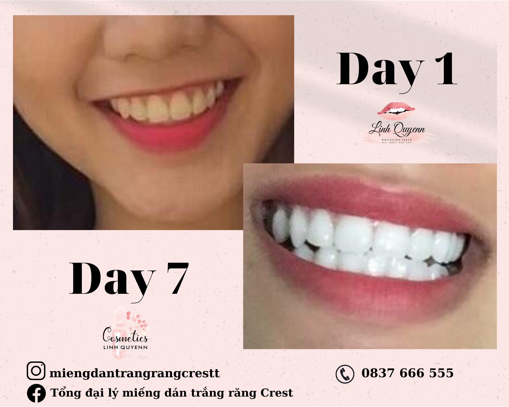 Miếng dán trắng răng Crest Supreme Professional (Trắng rất nhanh) - Combo 7 gói