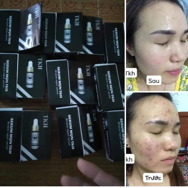 Serum Mụn Trần Kim Huyền