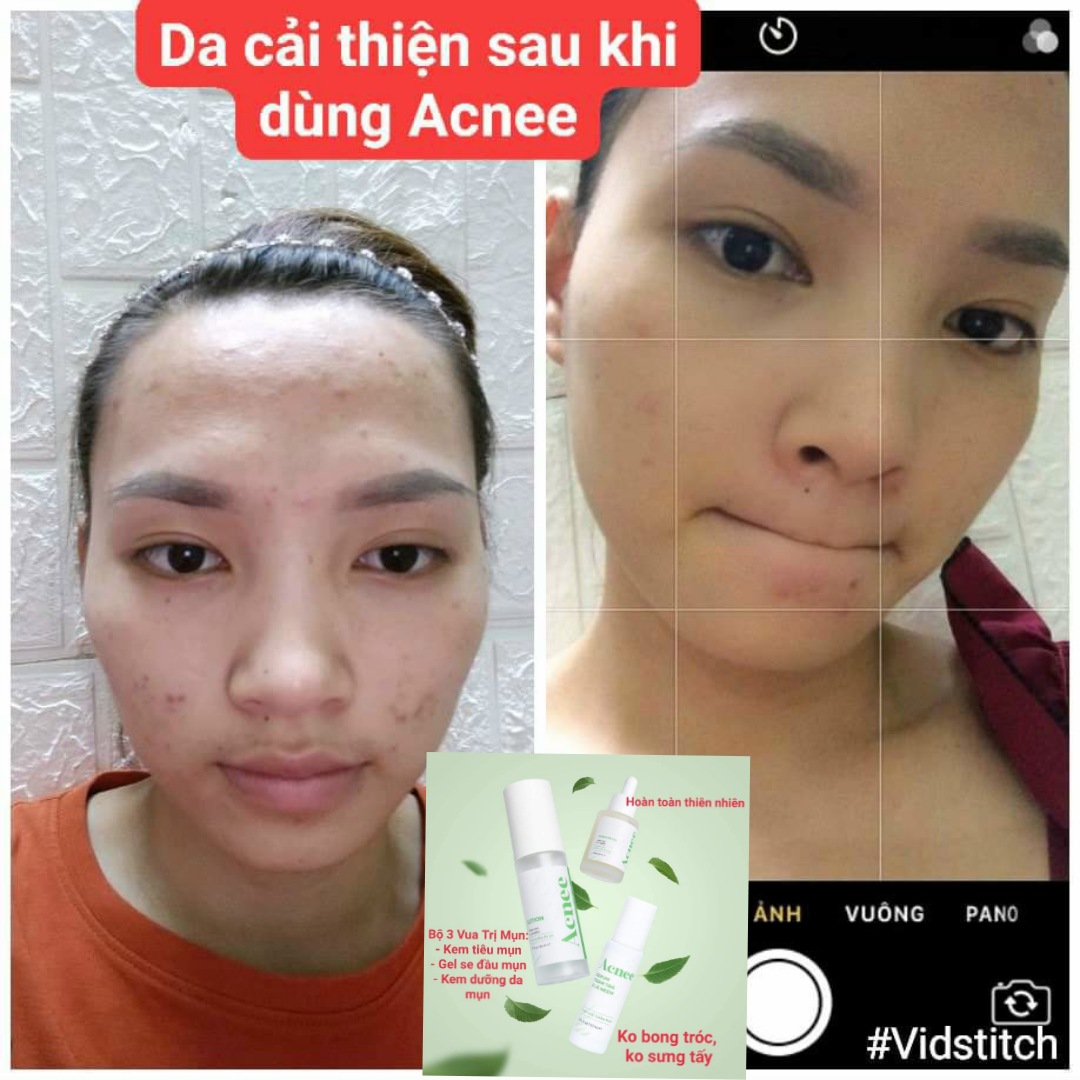 Trị Mụn Laco - bộ 3 Trị Mụn Laco [Tặng Sữa Rửa mặt]